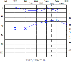 Audiogram showing conductive hearing loss.